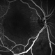 Macular Infarction in Systemic Lupus Erythematosus Macular Infarction in Systemic Lupus Erythematosus
